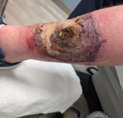 Original ulcer wound with necrotic tissue